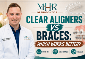 Clear Aligners vs Braces: Which Works Better?