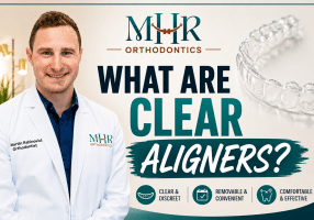 What Are Clear Aligners?